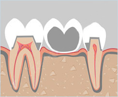 Традиционный мостовидный протез