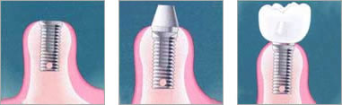 Этапы имплантации зубов