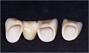 коронки VITA IN ALUMINIA