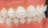 Центр эстетической стоматологии - металлические брекеты