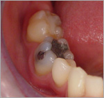 амальгамовая пломба - лечение зубов