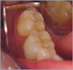 амальгамовая пломба заменена композитной пломбой