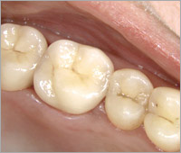 Коронки на каркасе из диоксида циркония CerconR
