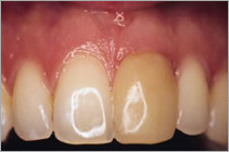 зубная коронка PROCERA