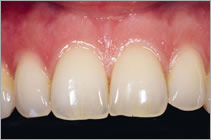 зубные коронки